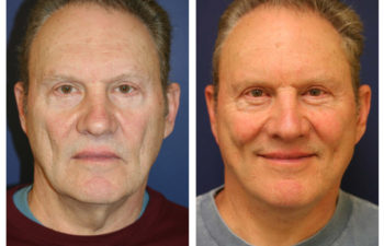 Male patient before and after facelift