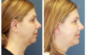 Female patient before and after facelift