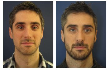 Male patient before and after closed rhinoplasty
