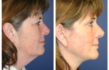Female patient before and after facelift