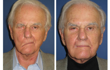 Male patient before and after facial nerve paralysis treatment