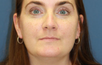 Female patient before and after cheek reconstruction