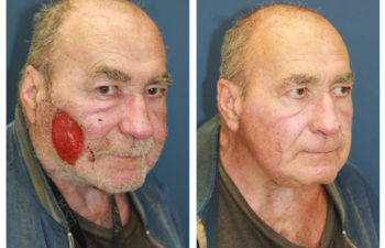 Male patient before and after cheek reconstruction