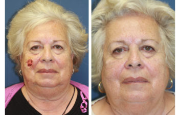 Female patient before and after cheek reconstruction