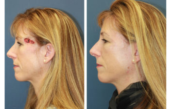 Female patient before and after forehead reconstruction