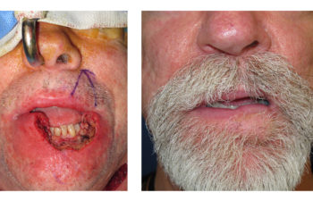 Male patient before and after lip reconstruction