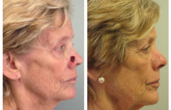 Female patient before and after nose reconstruction
