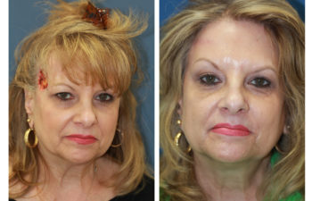 Female patient before and after forehead reconstruction