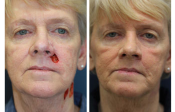 Female patient before and after facial reconstruction