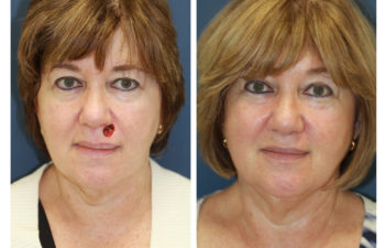 Female patient before and after facial reconstruction