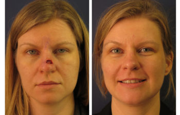 Female patient before and after nose reconstruction
