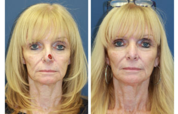 Female patient before and after nose reconstruction
