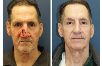 Male patient before and after nose reconstruction
