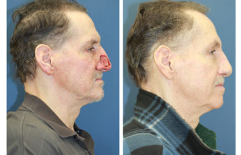 Male patient before and after nose reconstruction