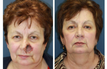 Female patient before and after nose reconstruction