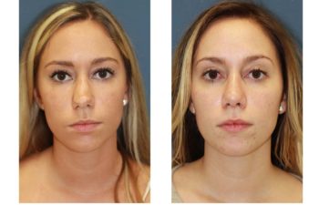 Female patient before and after open rhinoplasty