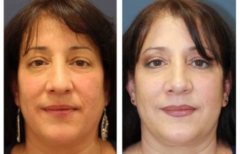 Female patient before and after open rhinoplasty