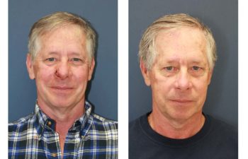 Male patient before and after nose reconstruction