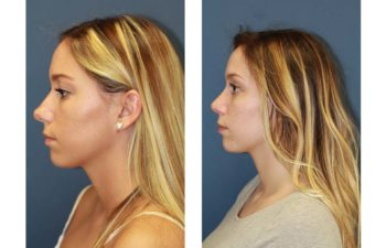 Female patient before and after open rhinoplasty
