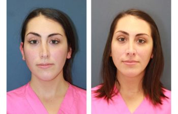 Female patient before and after revision open rhinoplasty