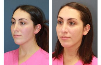 Female patient before and after revision open rhinoplasty