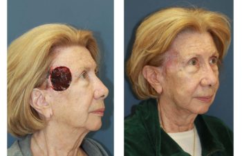 Female patient before and after forehead reconstruction
