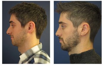 Male patient before and after closed rhinoplasty