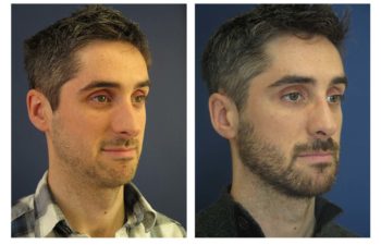 Male patient before and after closed rhinoplasty