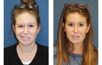 Female patient before and after facial nerve paralysis treatment