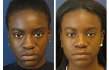 Afro-American Female patient before and after ethnic rhinoplasty