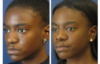 Afro-American Female patient before and after ethnic rhinoplasty