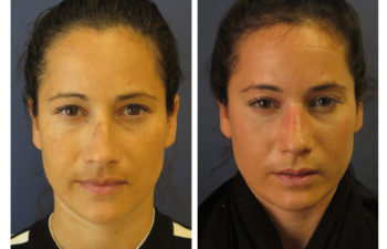 Female patient before and after closed rhinoplasty
