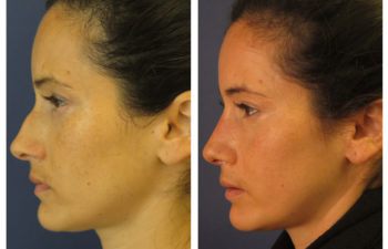 Female patient before and after closed rhinoplasty