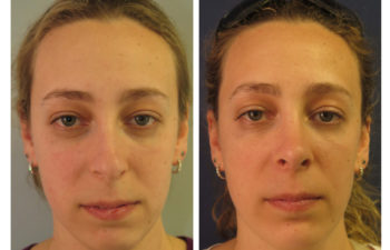 Female patient before and after rhinoplasty and chin implant surgery