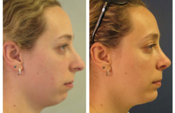 Female patient before and after rhinoplasty and chin implant surgery