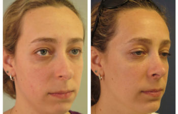 Female patient before and after rhinoplasty and chin implant surgery