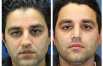 Male patient before and after rhinoplasty