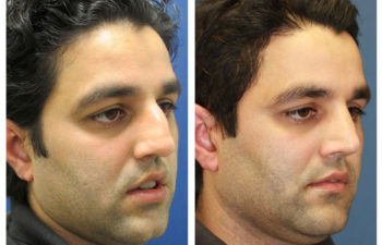 Male patient before and after rhinoplasty