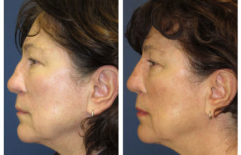 Female patient before and after revision closed rhinoplasty