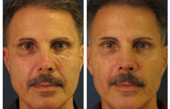 Male patient before and after revision rhinoplasty