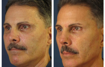 Male patient before and after revision rhinoplasty