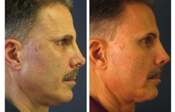 Male patient before and after revision rhinoplasty