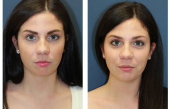 Female patient before and after facial countour reconstruction