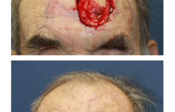 Male patient before and after forehead reconstruction