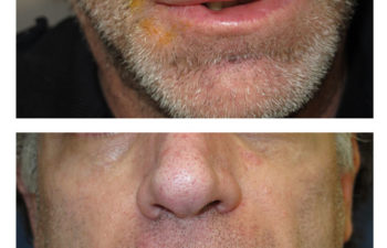 Male patient before and after lip reconstruction