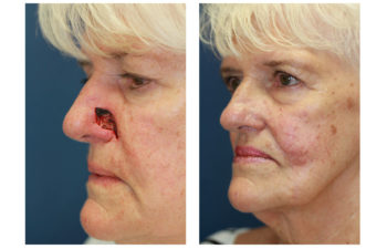 Female patient before and after nose reconstruction