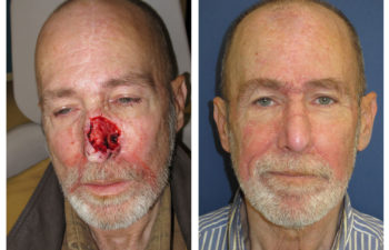 Male patient before and after nose reconstruction