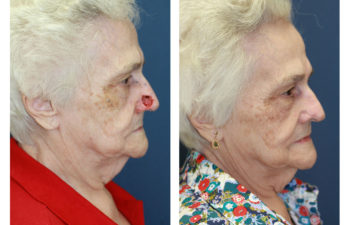 Female patient before and after nose reconstruction
