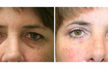 Patient before and after upper and lower blepharoplasty