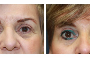 Patient before and after upper and lower blepharoplasty